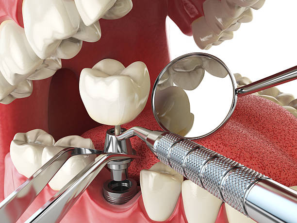 Best Emergency Dental Surgery in Wchester, IN